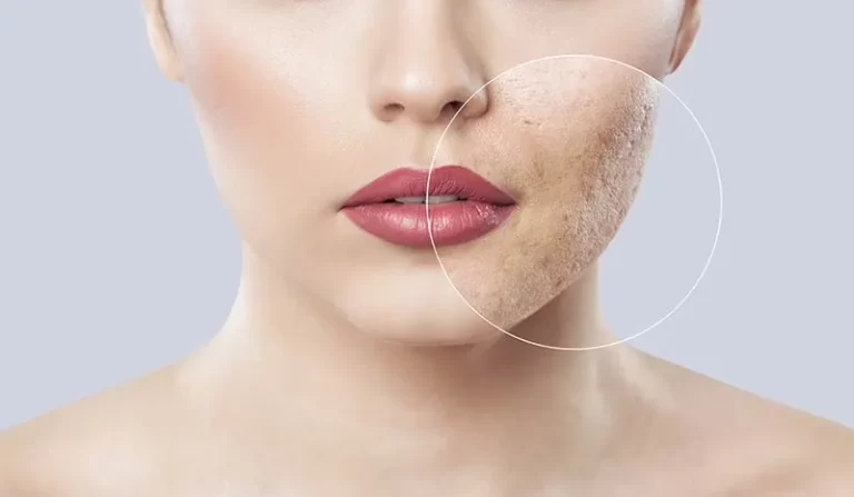 Laser Skin Tightening: Mechanism